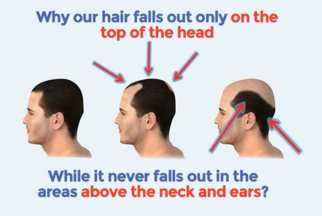 Hair loss cure - Treatments for thinning hair - Baldness cure