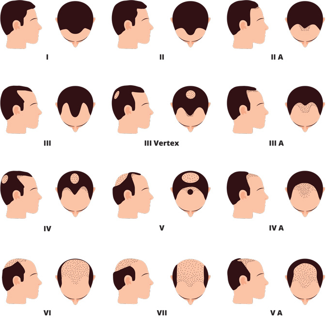 Norwood Hair Loss Chart