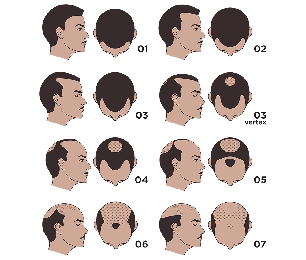 Norwood Hair Loss Chart