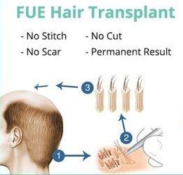 FUE hair transplant method