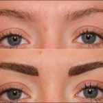 eyebrow transplant before and after