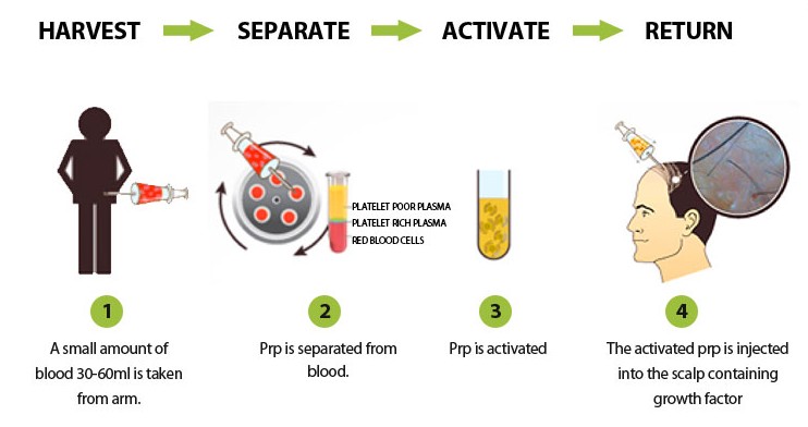 prp therapy and treatment for hair rejuvenation