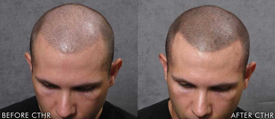 Micro scalp pigmentation (SMP) - Hair pigmentation treatment: hairline tattoo