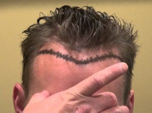 Receding hairline, mature hairline treatment