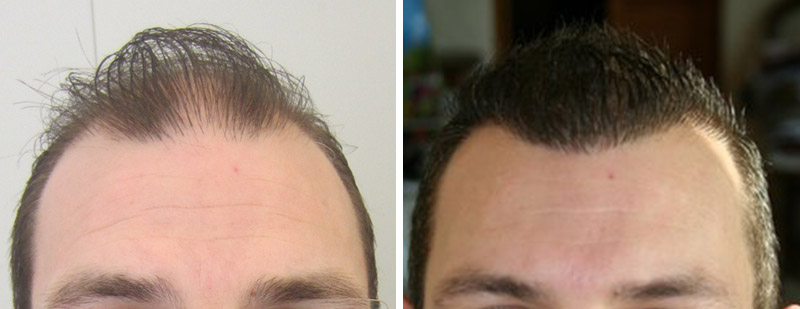 Hair transplant before and after images - Hair Clinic Hungary