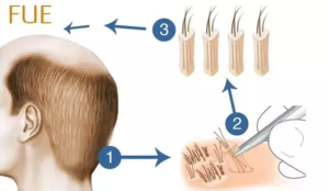 Hair transplant surgery: stop hair loss immediately!