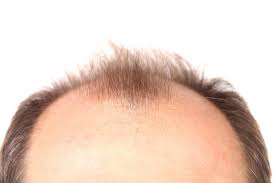 Latest cure for hair loss / baldness