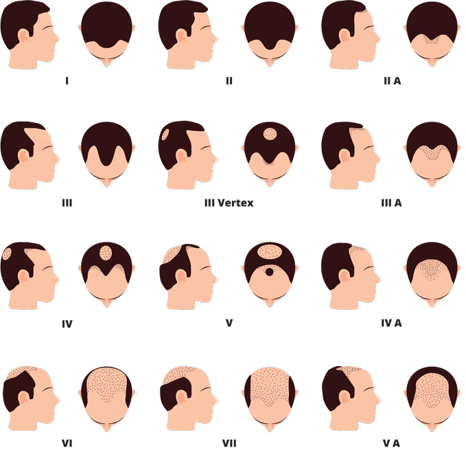 Male pattern baldness: Norwood scale with mature hairline
