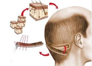 FUT / FUSS hair transplant method