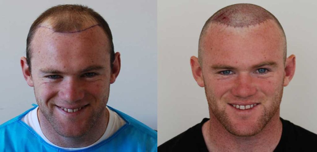 Wayne Rooney hair transplant story