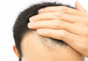 Hair loss treatment work