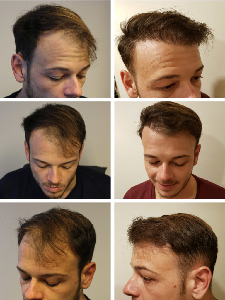Come rendere i capelli piu spessi - Stempiatura uomo