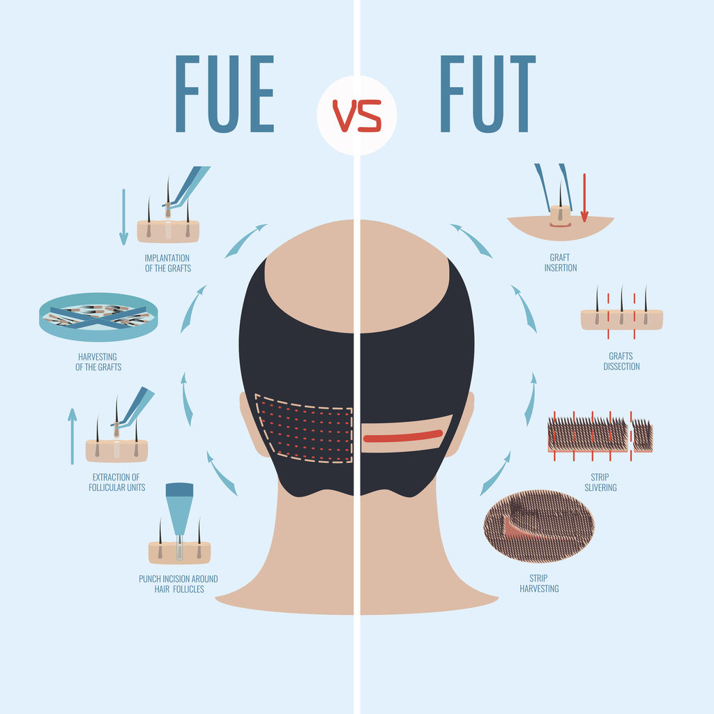 FUT vs FUE hair transplant differences