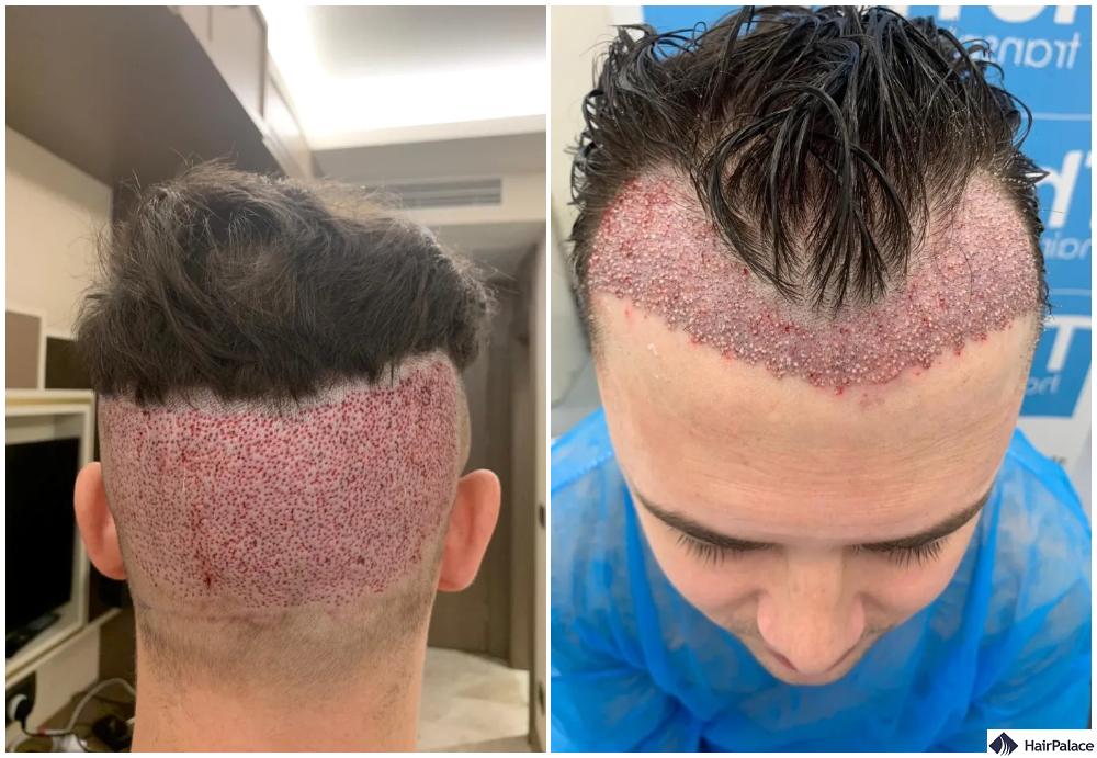 Turkey Hair Transplant Risks